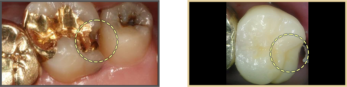 충치치료 증례01