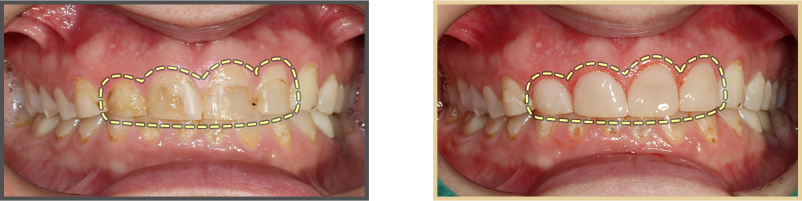 충치치료 증례02