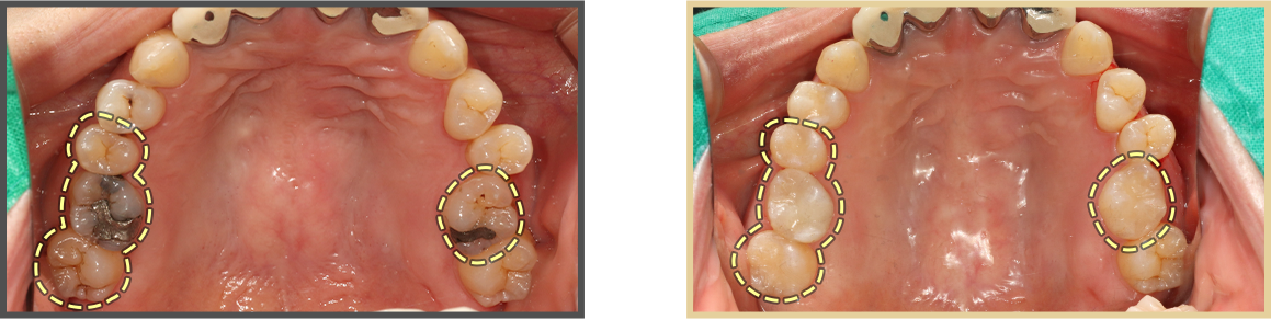 충치치료 증례04