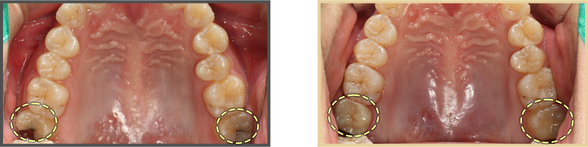 충치치료 증례04
