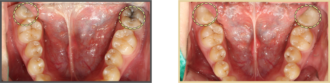 충치치료 증례05