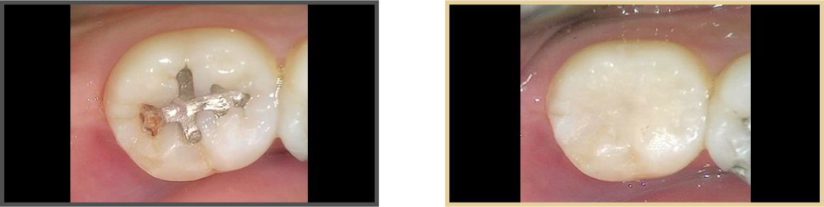 충치치료 증례06