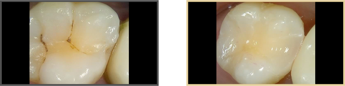 충치치료 증례07