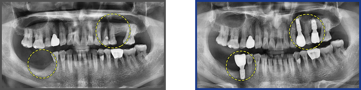 임플란트 증례01