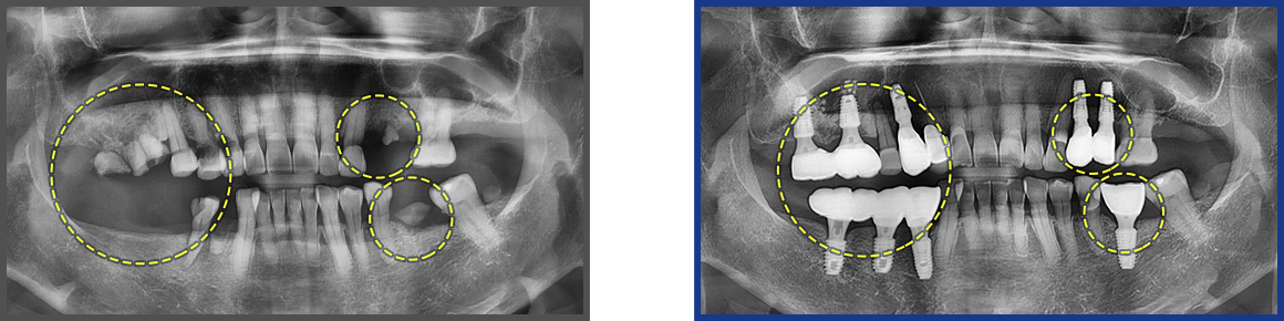 임플란트 증례02