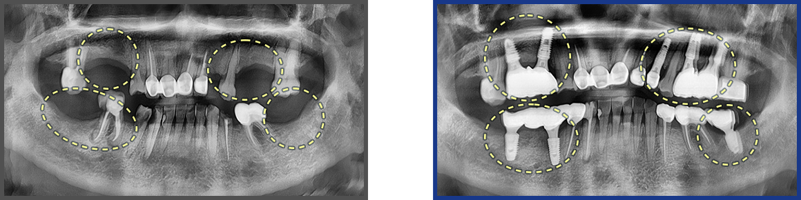 임플란트 증례03