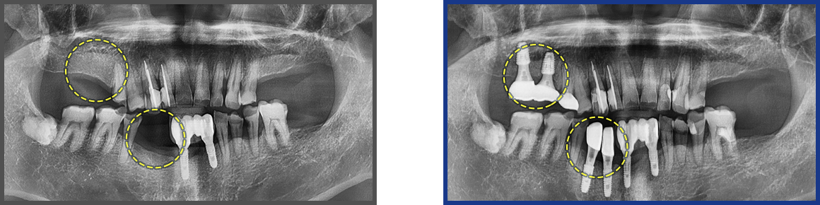임플란트 증례04