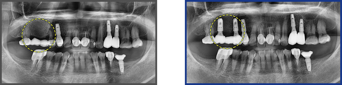 임플란트 증례05