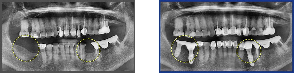 임플란트 증례06
