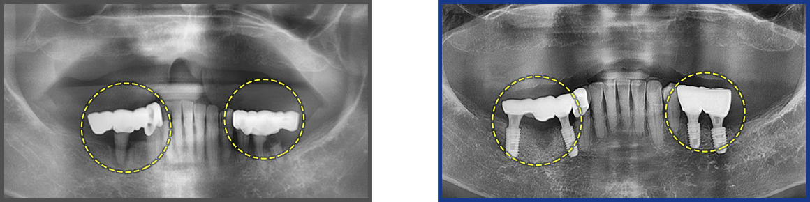임플란트 증례07
