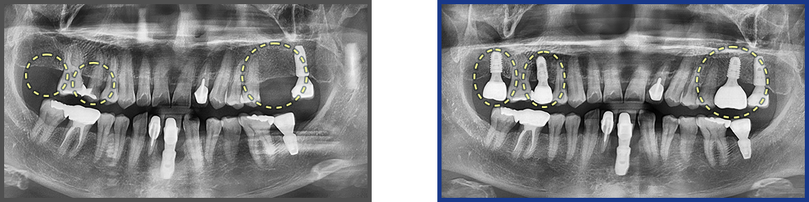 임플란트 증례08