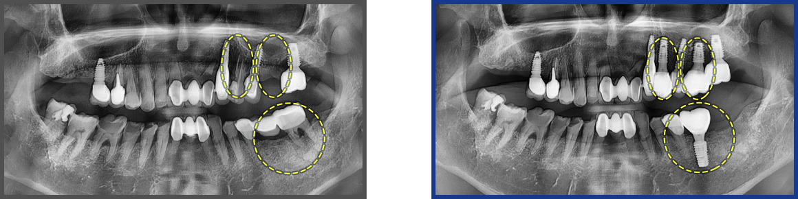 임플란트 증례09