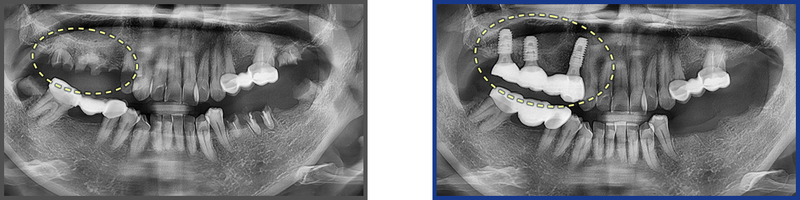 임플란트 증례10