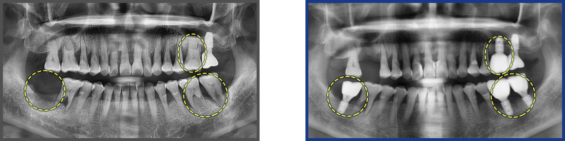 임플란트 증례11