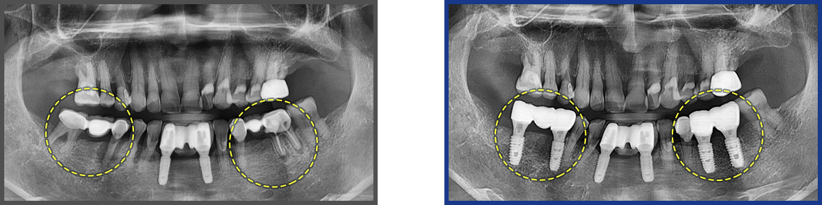 임플란트 증례17