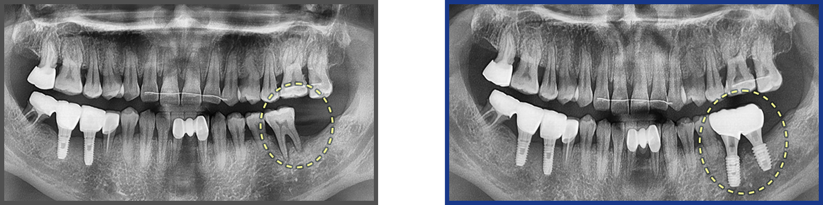 임플란트 증례18