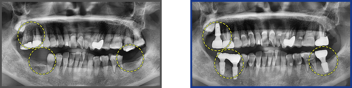 임플란트 증례19