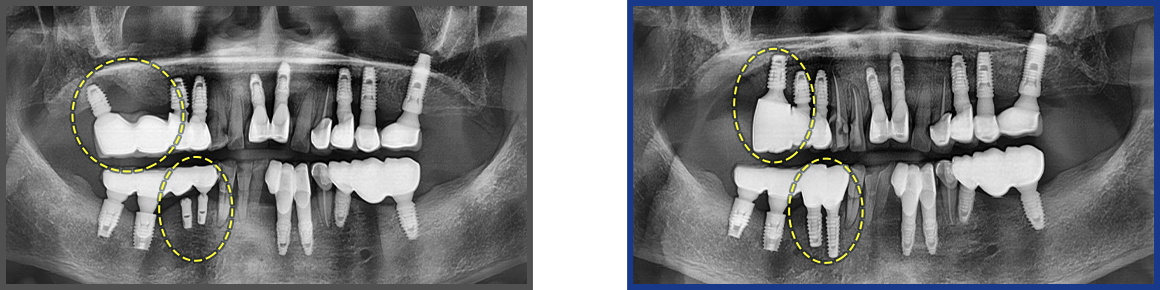 임플란트 증례20