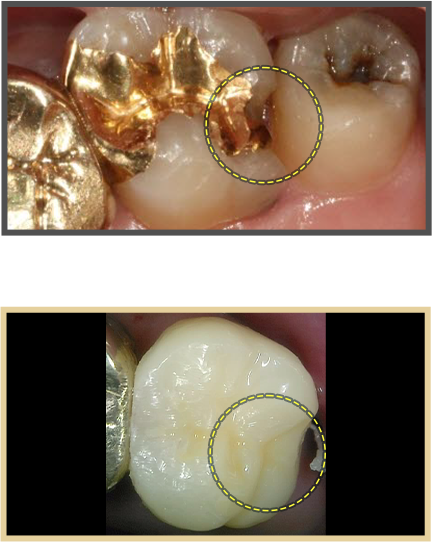 충치치료 증례01