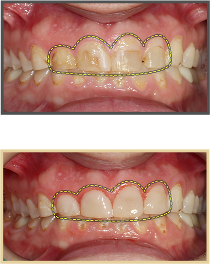 충치치료 증례02