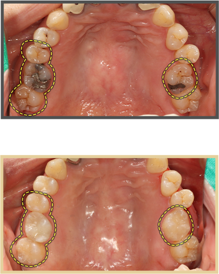 충치치료 증례04