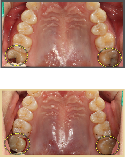 충치치료 증례04