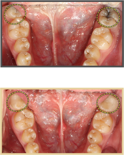 충치치료 증례05