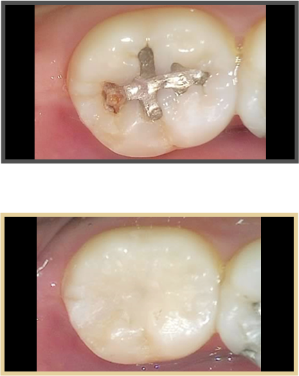 충치치료 증례06