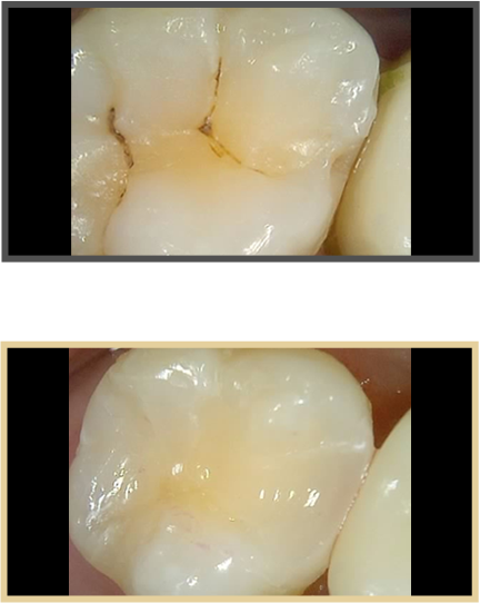 충치치료 증례07