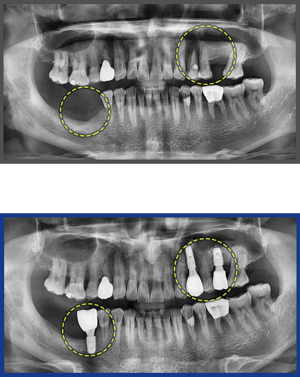 임플란트 증례01