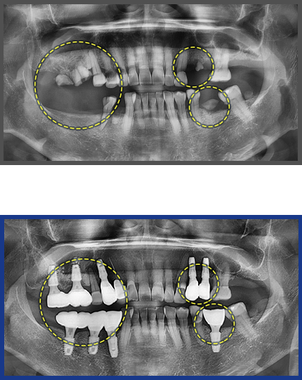 임플란트 증례02
