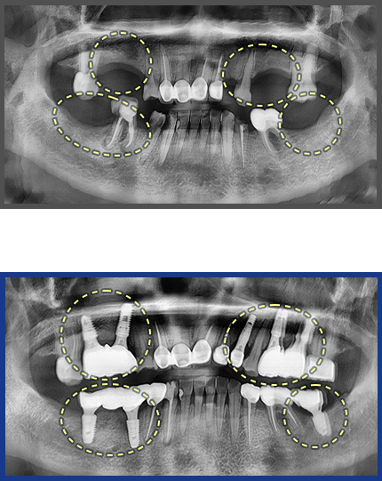 임플란트 증례03