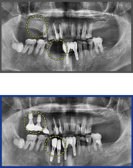 임플란트 증례04