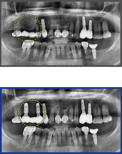 임플란트 증례05