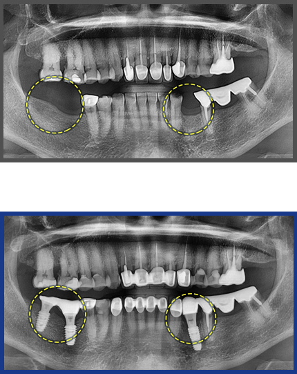임플란트 증례06