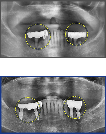 임플란트 증례07