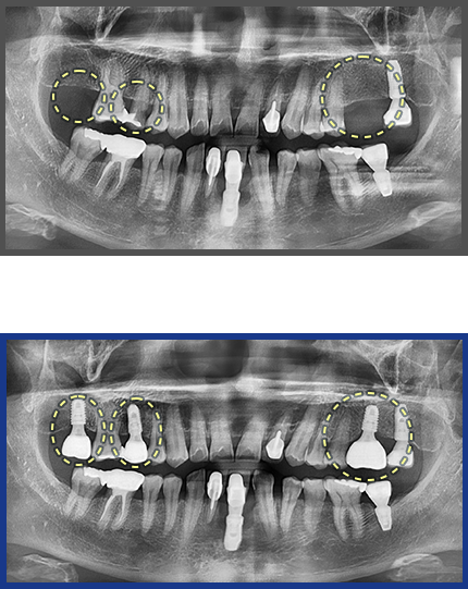 임플란트 증례08