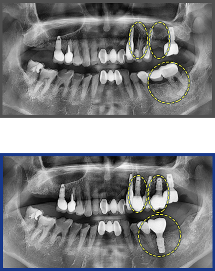 임플란트 증례09