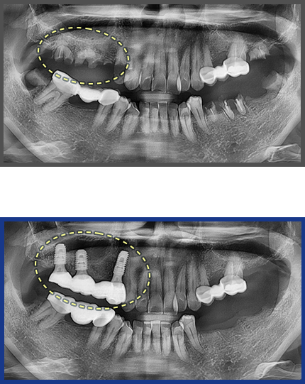 임플란트 증례10