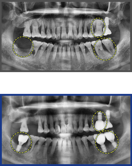 임플란트 증례11