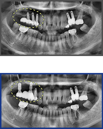 임플란트 증례12