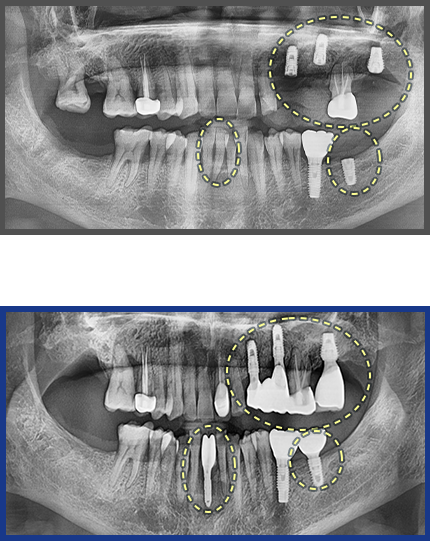 임플란트 증례13
