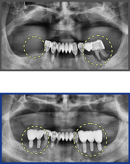 임플란트 증례14