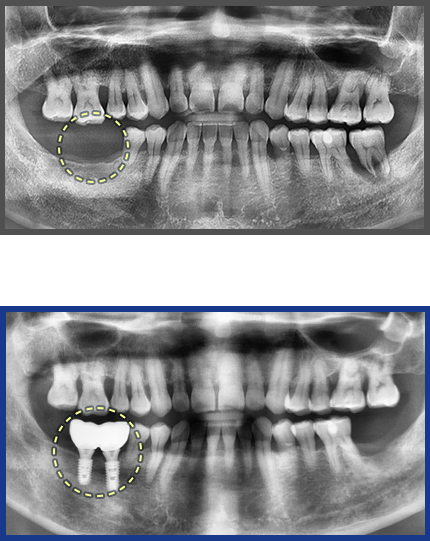 임플란트 증례15