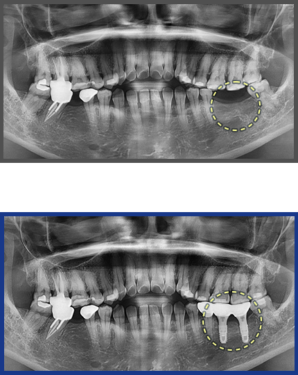 임플란트 증례16
