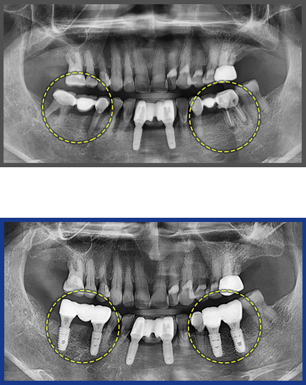 임플란트 증례17