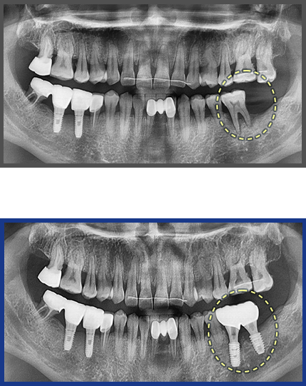 임플란트 증례18