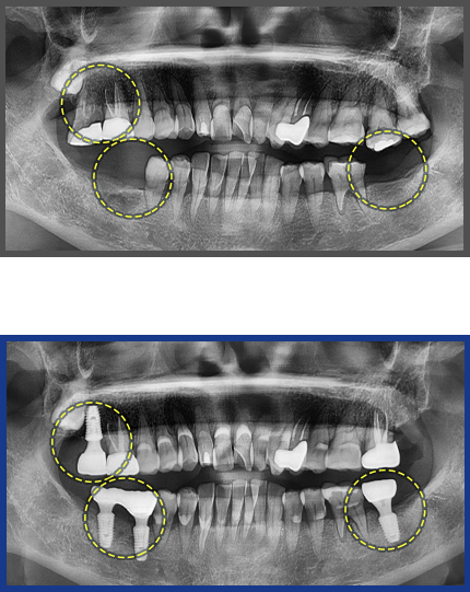 임플란트 증례19