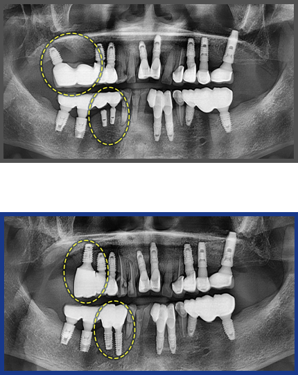 임플란트 증례20