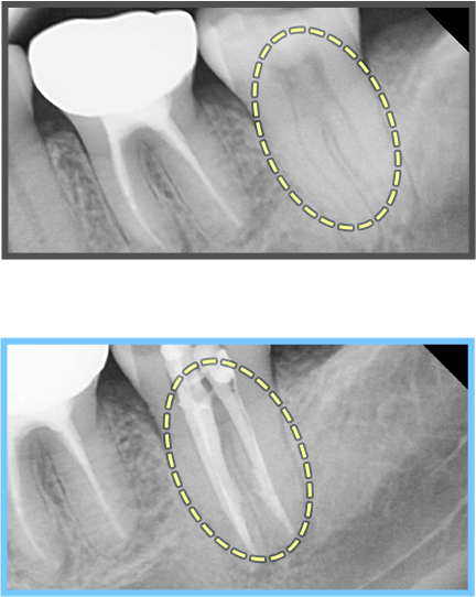 심미보철 증례04